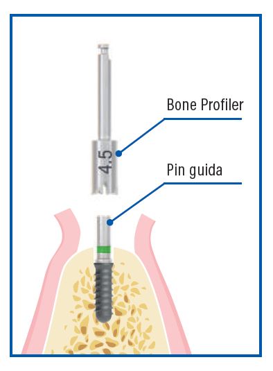 PIN GUIDA PER BONE PROFILER LEONE – Esadental